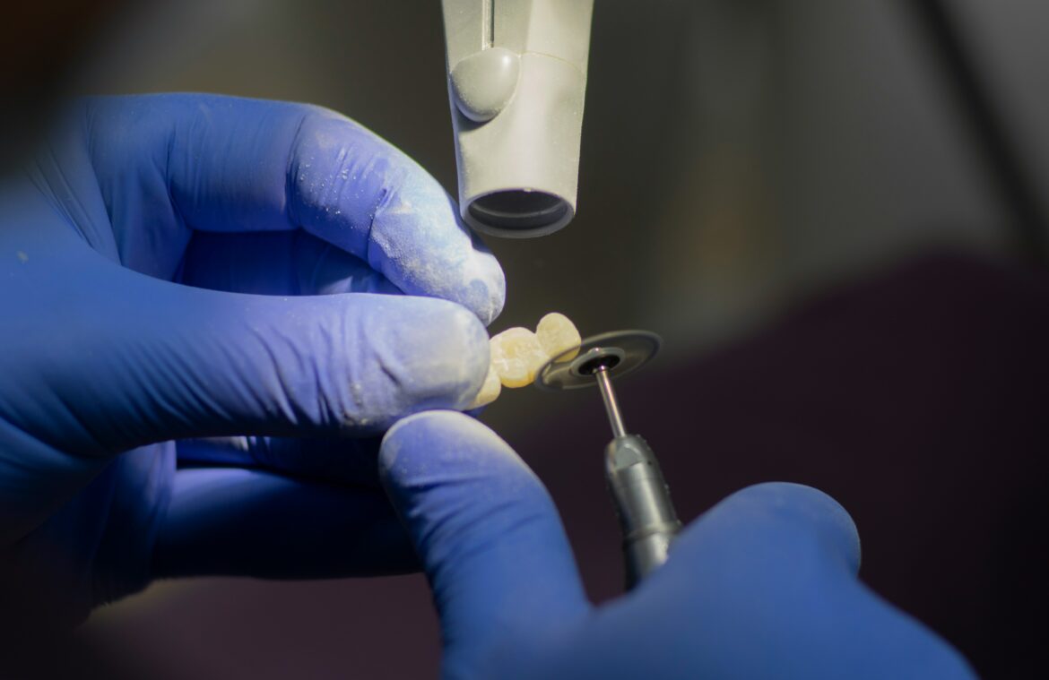 Prothèse sur implant à Sanary